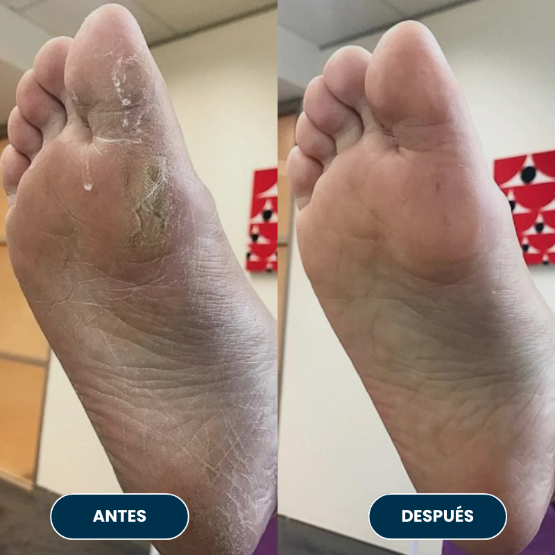 Lijadora anti-callos