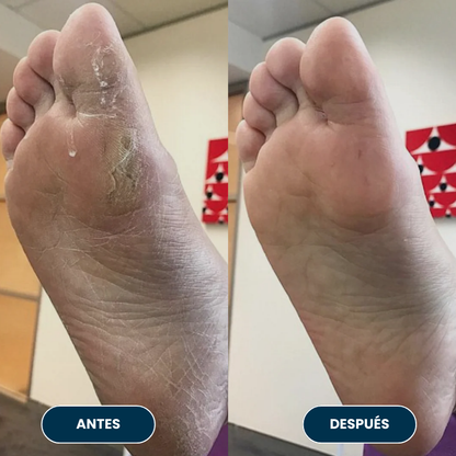 Lijadora anti-callos